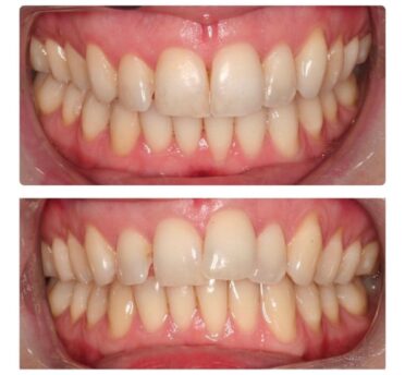 Invisalign® case 2 by Campden House