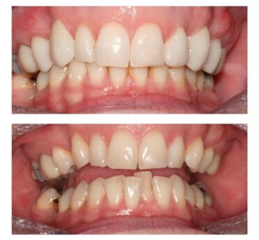 Invisalign® case 3 by Campden House