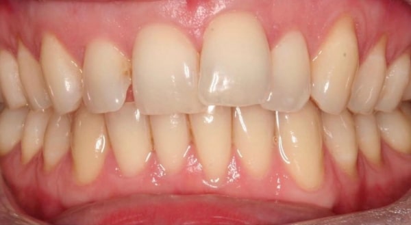 Before - Campden House Dental