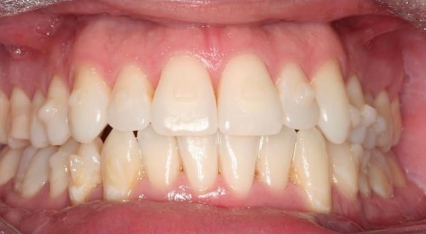 After - Campden House Dental