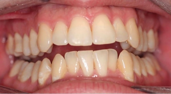 Before - Campden House Dental