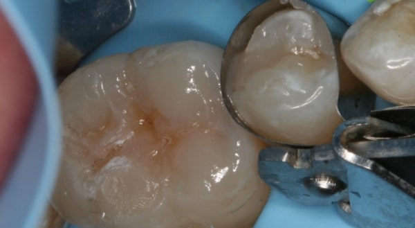 After - Campden House Dental