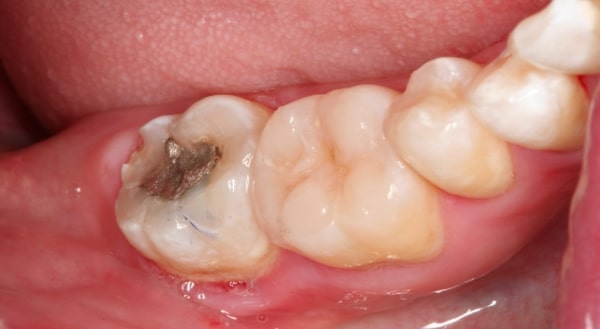 Before - Campden House Dental