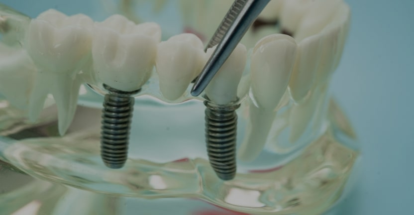 Treatments - Campden House Dental